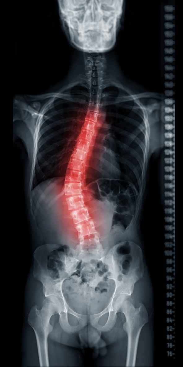 Imagem de um raio-x da coluna vertebral com escoliose idiopática