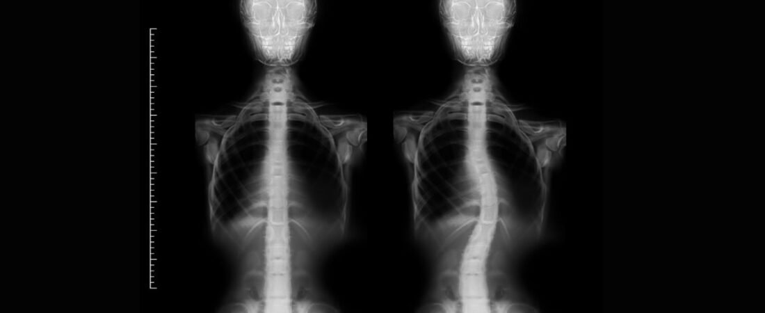 Escoliose: Causas, Sintomas e Tratamento