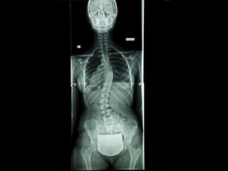 Imagem mostrando um Raio-X de uma coluna vertebral com escoliose idiopática