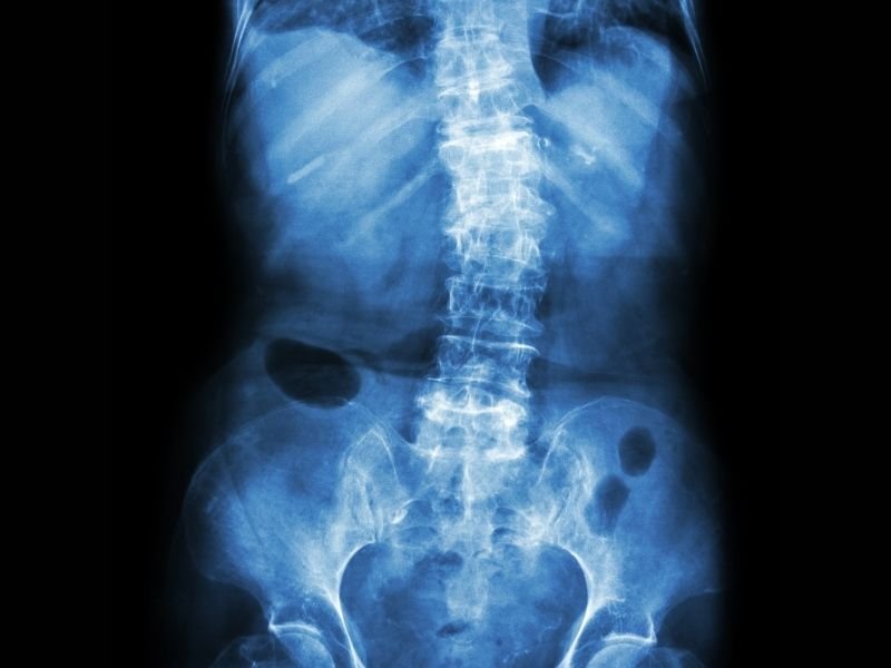 Imagem de um Raio-X, mostrando uma escoliose degenerativa