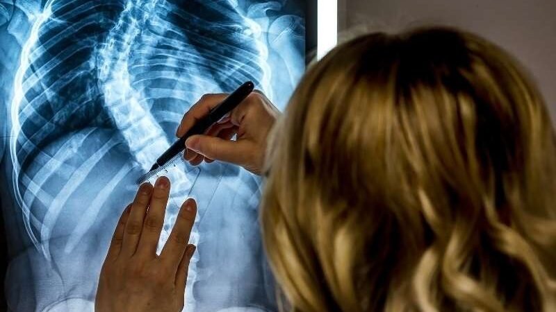 Tratamento da Escoliose: Método Schroth em Foz do Iguaçu-PR