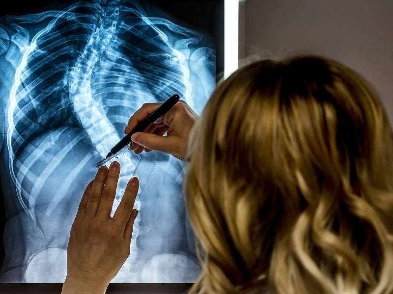 Tratamento da Escoliose: Método Schroth em Foz do Iguaçu-PR