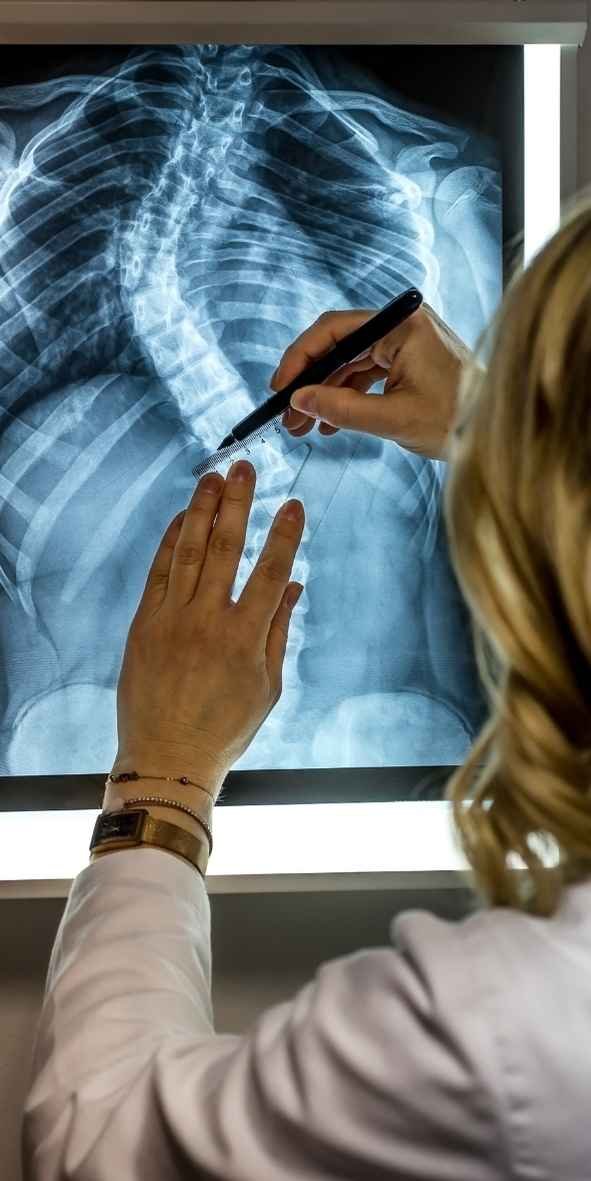 Imagem mostrando um fisioterapeuta fazendo a medida do angulo de cobb para medir o grau da escoliose idiopática no EscolioBlog